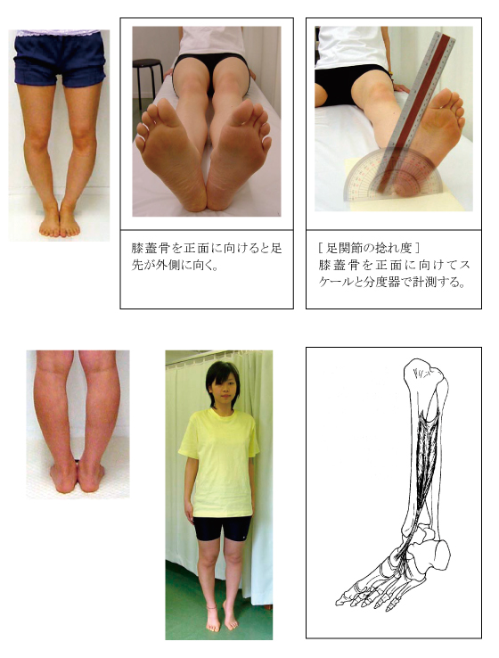 膝蓋骨が内側に向けば向くほど足関節の捻れ度が大きくなります。 
